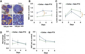 Targeting of metastasis-promoting tumor-associated fibroblasts and modulation of pancreatic tumor-associated stroma with a carboxymethylcellulose-docetaxel nanoparticle.